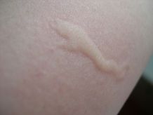 mosquito-bite art photography